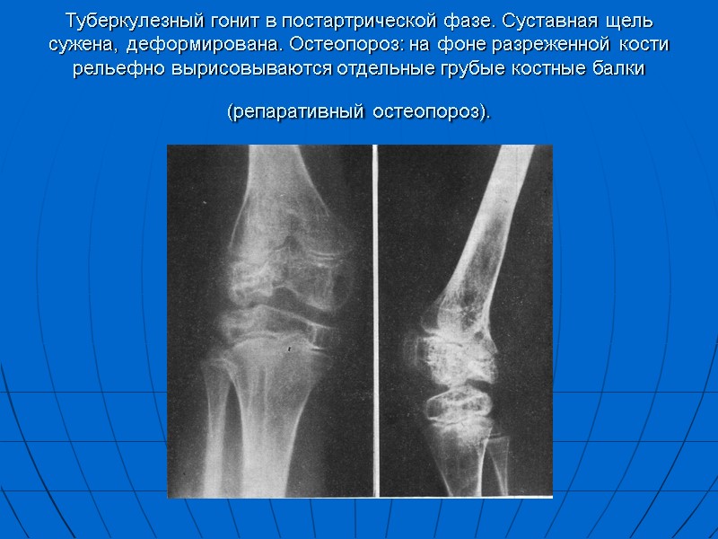 Туберкулезный гонит в постартрической фазе. Суставная щель сужена, деформирована. Остеопороз: на фоне разреженной кости